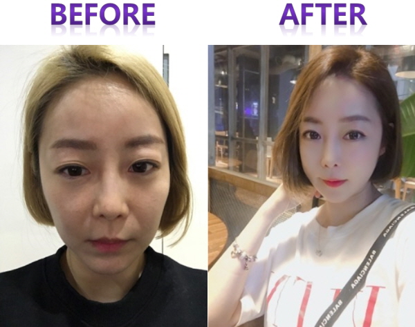 ID Plastic Surgery Hospital Korea - Before & After Breast